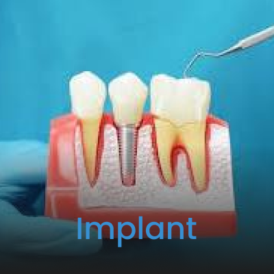 Implant